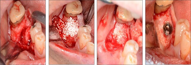 歯が抜けて痩せてしまったところにサイトランスを埋植すると、自身の骨に置き換わって新しい骨を形成し、インプラントの土台を埋め込むことが可能になります。