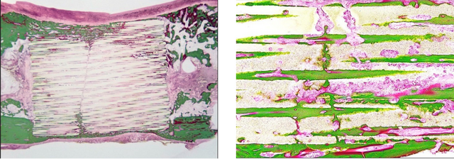 緑色の部分が骨芽細胞。徐々に侵食して、自分の骨に入れ替わります。炭酸アパタイトは骨芽細胞を活性化し、新しい骨の形成を促進する骨伝導性に優れています。